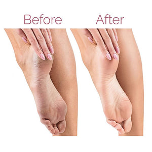 Electric Pedicure Foot File Callus Remover – Rechargeable Foot Care Device for Smooth Heels – UAE